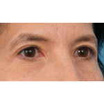 Quad Blepharoplasty Before & After Patient #3331