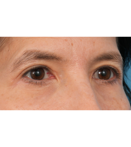 Quad Blepharoplasty Before & After Patient #3331