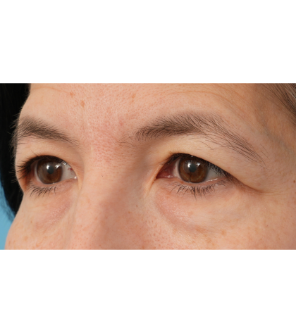 Quad Blepharoplasty Before & After Patient #3331