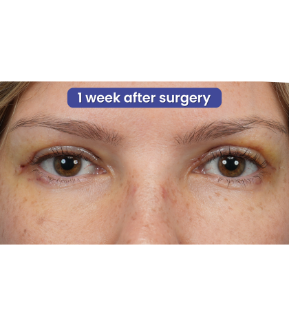 Upper Blepharoplasty Before & After Patient #3293