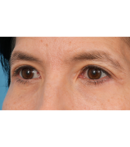 Quad Blepharoplasty Before & After Patient #3331