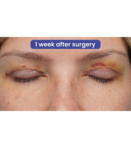 Upper Blepharoplasty Before & After Patient #3293