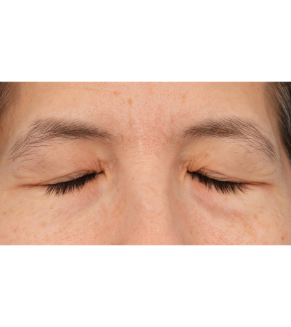 Quad Blepharoplasty Before & After Patient #3331
