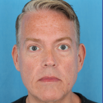 Facelift Before & After Patient #3364