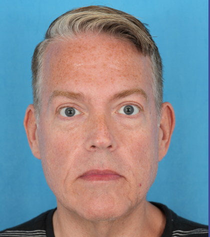 Facelift Before & After Patient #3364