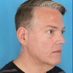 Facelift Before & After Patient #3364