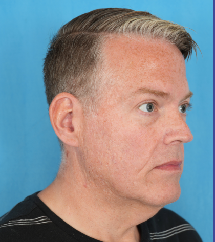 Facelift Before & After Patient #3364