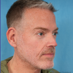 Facelift Before & After Patient #3364