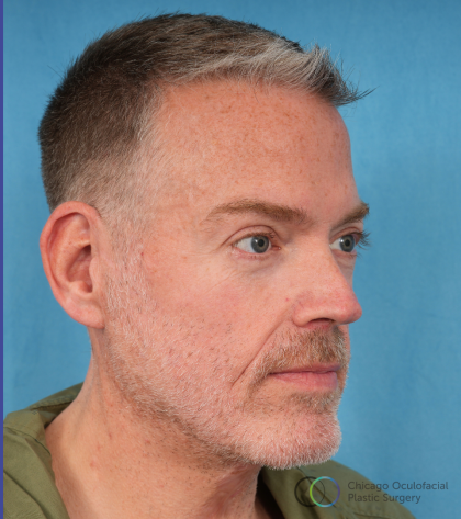 Facelift Before & After Patient #3364