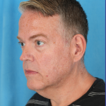 Facelift Before & After Patient #3364