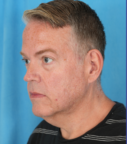 Facelift Before & After Patient #3364