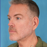 Facelift Before & After Patient #3364