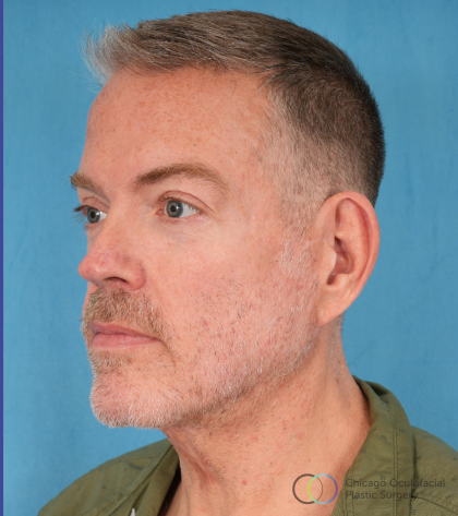 Facelift Before & After Patient #3364