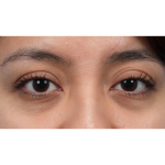 Dark Circles Before & After Patient #3345