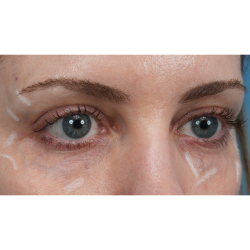 Vein Removal Before & After Patient #3371