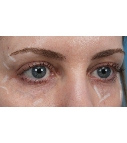 Vein Removal Before & After Patient #3371