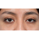 Dark Circles Before & After Patient #3345