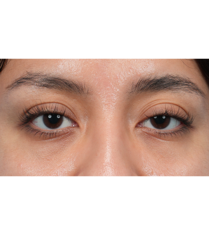 Dark Circles Before & After Patient #3345