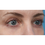 Vein Removal Before & After Patient #3371
