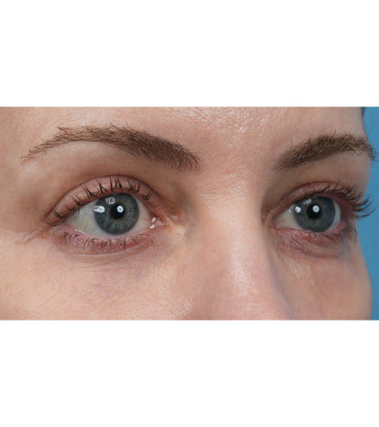 Vein Removal Before & After Patient #3371