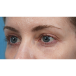 Vein Removal Before & After Patient #3371