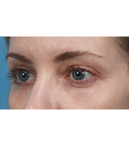 Vein Removal Before & After Patient #3371