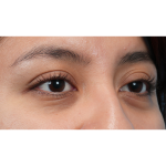 Dark Circles Before & After Patient #3345