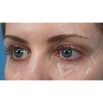 Vein Removal Before & After Patient #3371