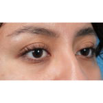 Dark Circles Before & After Patient #3345