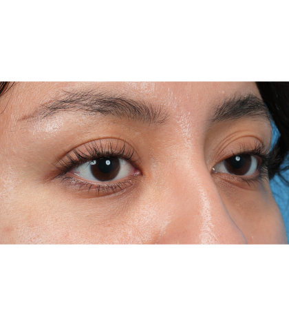 Dark Circles Before & After Patient #3345