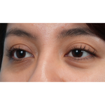 Dark Circles Before & After Patient #3345