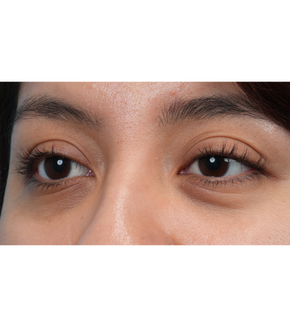 Dark Circles Before & After Patient #3345