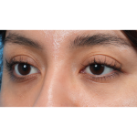 Dark Circles Before & After Patient #3345