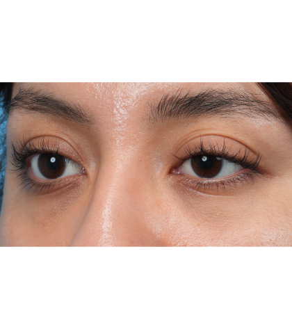 Dark Circles Before & After Patient #3345