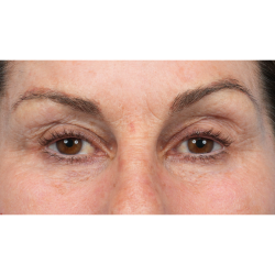 Revision Blepharoplasty Before & After Patient #3418