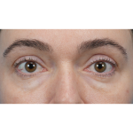 CO2 Laser Resurfacing Before & After Patient #3400