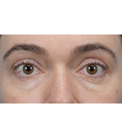 CO2 Laser Resurfacing Before & After Patient #3400