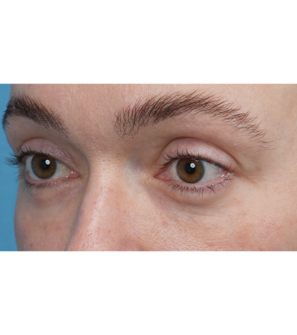 CO2 Laser Resurfacing Before & After Patient #3400