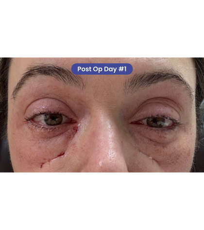 CO2 Laser Resurfacing Before & After Patient #3400