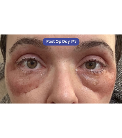 CO2 Laser Resurfacing Before & After Patient #3400