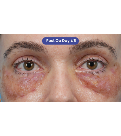 CO2 Laser Resurfacing Before & After Patient #3400