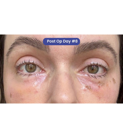 CO2 Laser Resurfacing Before & After Patient #3400