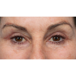 Revision Blepharoplasty Before & After Patient #3418
