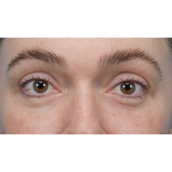 CO2 Laser Resurfacing Before & After Patient #3400