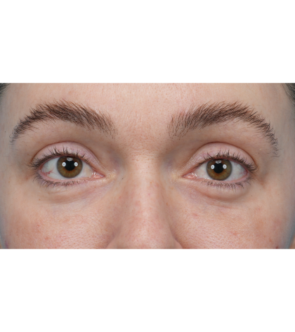 CO2 Laser Resurfacing Before & After Patient #3400