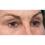 Revision Blepharoplasty Before & After Patient #3418