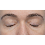 CO2 Laser Resurfacing Before & After Patient #3400