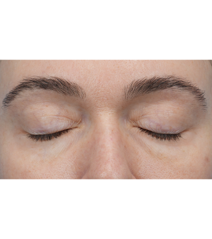 CO2 Laser Resurfacing Before & After Patient #3400