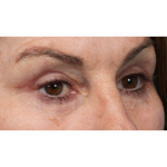 Revision Blepharoplasty Before & After Patient #3418
