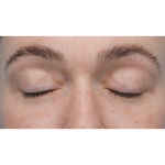 CO2 Laser Resurfacing Before & After Patient #3400